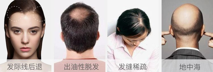 ▲ 头发一抓掉一把，发量一天天减少，发际线越来越高。