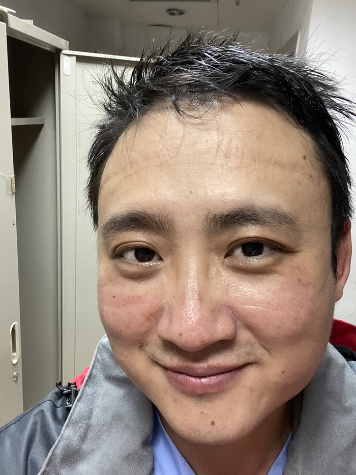 脱下防护装备的李静，脸上都是勒痕