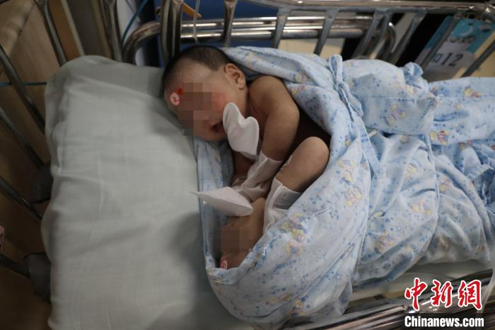     出生仅36天的联体姐妹肝脏相连。儿科医院供图