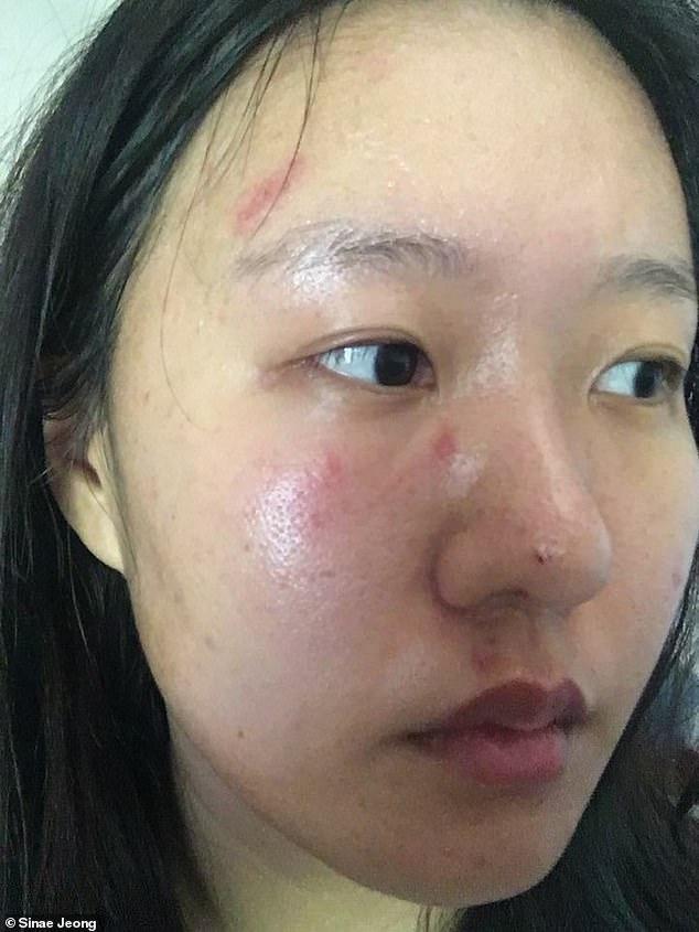 韩女子在澳遭6人群殴咒骂：滚回自己国家，头发被扯掉脸部肿胀