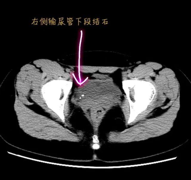 腹中剧痛3天，17岁姑娘忍着坚持学习！拍了CT，父母瞬间傻眼