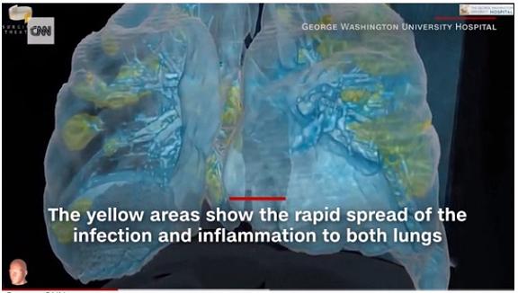 美医院发布3D视频 首次360度呈现新冠患者肺部损伤