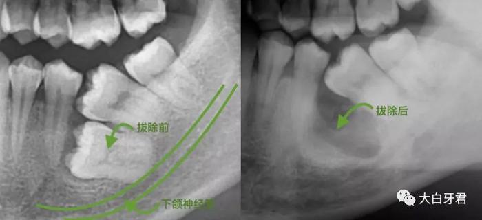 牙齿矫正的 3 大困扰，口腔科医生用亲身经历教你解决