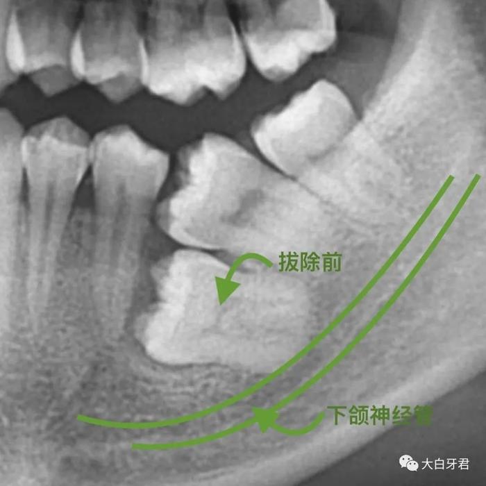 牙齿矫正的 3 大困扰，口腔科医生用亲身经历教你解决