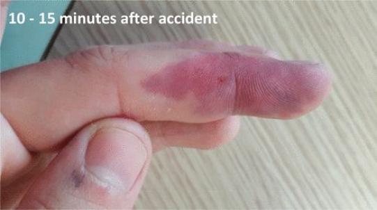 一个针头引发实验室惨案，研究生差点断送手指