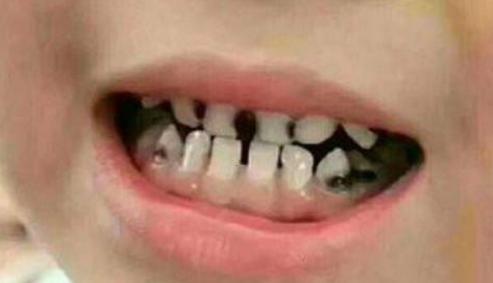 3岁儿子天天刷牙，半年后却满口“小黑牙”，医生：不是糖的事