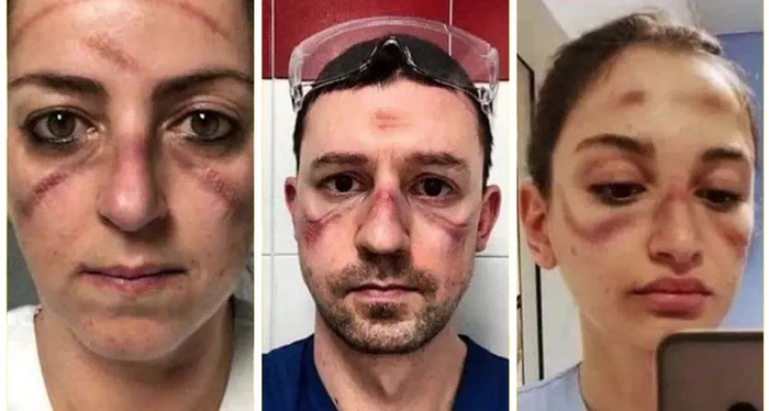 意大利护士和医生晒出脸上的勒出血痕的自拍照   图片来源：twitter