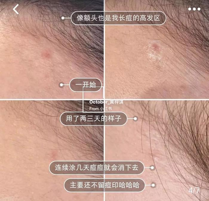 戴口罩闷出痘痘，还有人差点晕过去，怎么办？