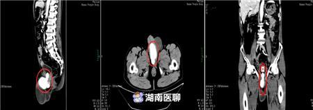 老汉阴部刺痛，尿道内长出鹅蛋结石！医生“一石二鸟”巧施手术