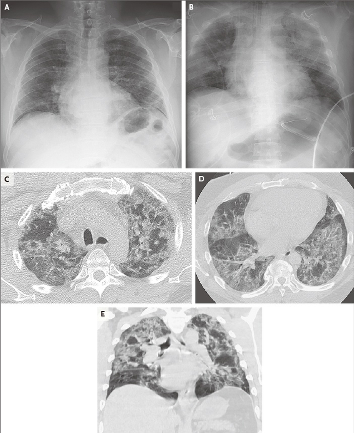 来自1例患者的代表性胸部图像，体现了肺部混浊的迅速发展和弥漫性特点