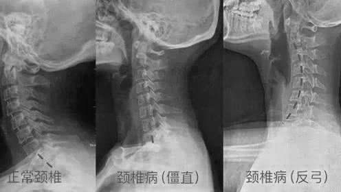 如果在上述阶段不加以重视，就会发展为颈椎反弓，甚至更为严重的后果