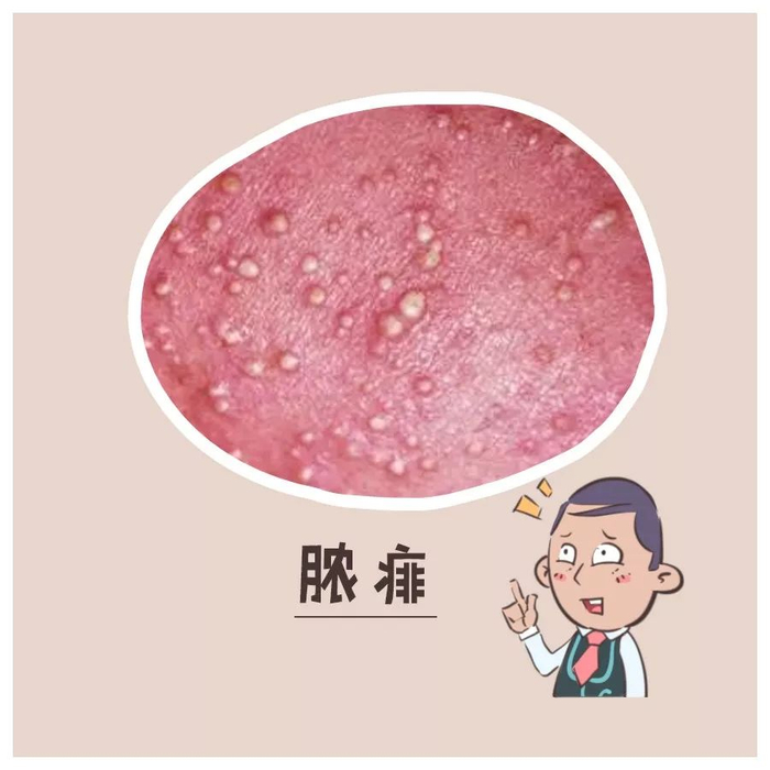 湿疹和痱子长的像,但处理办法大不同!|痱子_新浪新闻