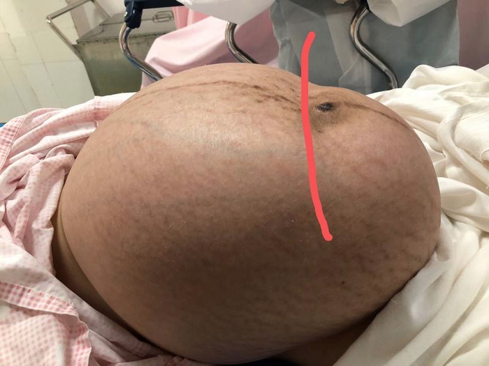 ▲红线是宫底，红线左边都是瘤体，红线右边是子宫