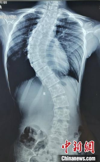 12岁女童脊柱弯曲如“S型” 手术后终于“挺直腰杆”