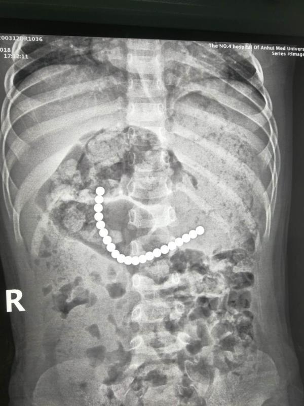 “熊孩子”误吞21颗磁珠 专家提醒：幼儿远离此类玩具