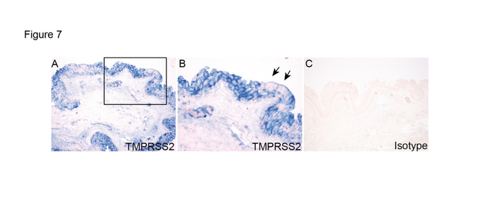  图6：结膜手术标本的TMPRSS2表达及定位。（A）框中的区域在（B）以较高的放大倍数显示。C为正常IgG对照组。