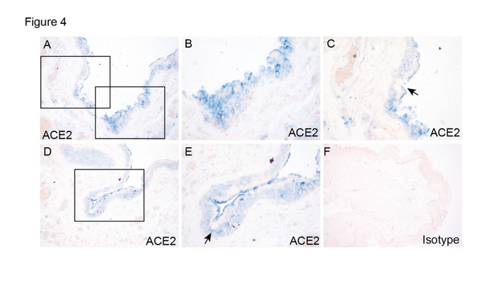 图3：结膜手术标本的ACE2表达及定位。（A）框中的区域在（B）和（C）以较高的放大倍数显示。（D）框中的区域在（E）以较高的放大倍数显示。箭头表示杯状细胞（C，E）。