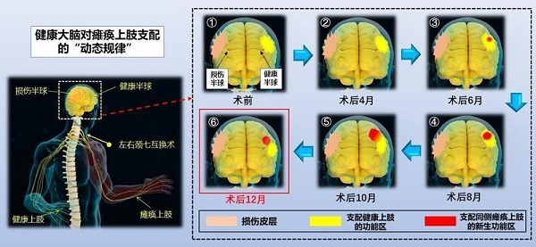 图说：“左右颈七互换术”诱发健康大脑半球可塑的动态规律示意图
