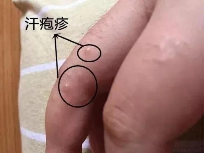 痒痒痒！姑娘手指长满小水泡还脱皮！医生：这症状夏天高发