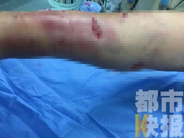西安女子被自家狗扑咬重伤 皮肤撕脱、多处骨折 诊断为狂犬病Ⅲ级暴露！