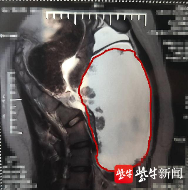 B超显示，15岁的小萱体内有一个直径约20厘米的肿瘤。（院方供图）