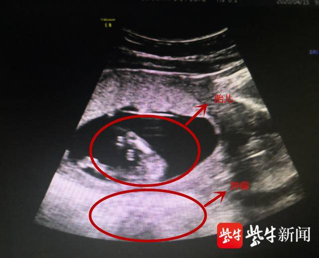 胎儿生命在腹中受直径约10厘米的肌瘤威胁。（院方供图）