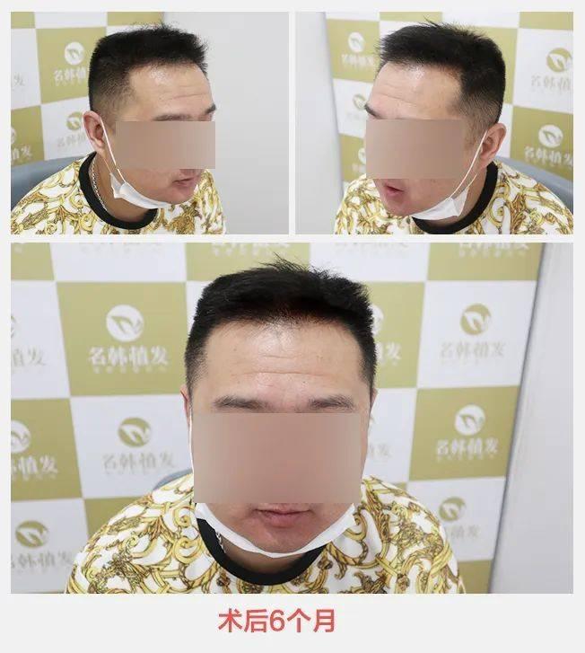 名韩植发认定(韩国植发技术怎么样)