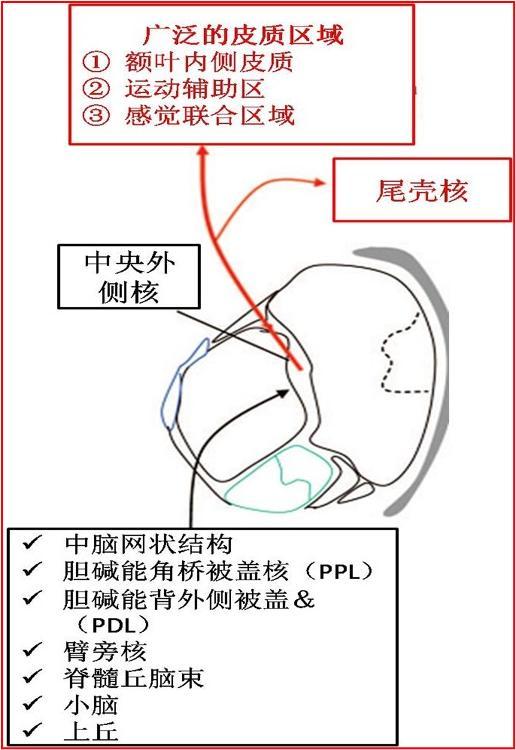 脑深部电刺激促醒长期意识障碍患者