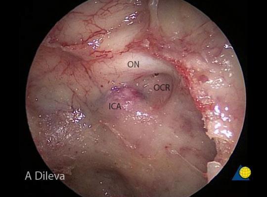 内镜,神经导航经蝶技术切除蝶窦病变|导航|垂体瘤|手术_新浪新闻