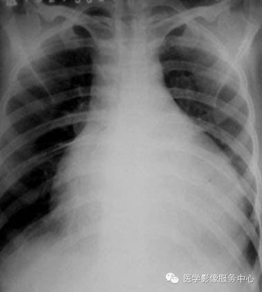 【图文】心包积液的影像学检查_新浪新闻