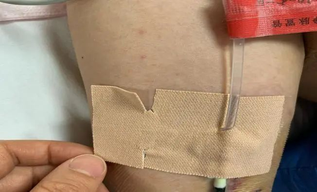 外科胶带怎么撕PICC这样固定,太安全了!_新闻资讯_第6张_活检穿刺产品网 外科胶带怎么撕PICC这样固定,太安全了!_https://www.jmylbn.com_新闻资讯_第6张