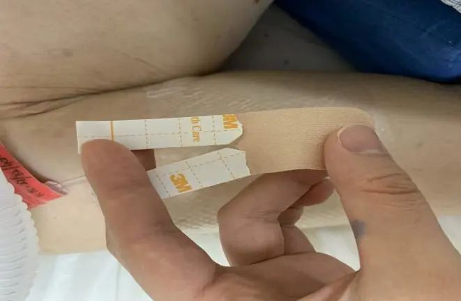 外科胶带怎么撕PICC这样固定,太安全了!_新闻资讯_第3张_活检穿刺产品网 外科胶带怎么撕PICC这样固定,太安全了!_https://www.jmylbn.com_新闻资讯_第3张