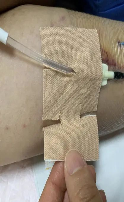 外科胶带怎么撕PICC这样固定,太安全了!_新闻资讯_第9张_活检穿刺产品网 外科胶带怎么撕PICC这样固定,太安全了!_https://www.jmylbn.com_新闻资讯_第9张