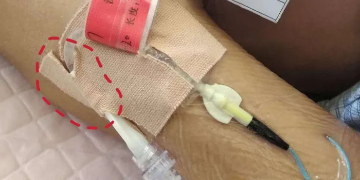 外科胶带怎么撕PICC这样固定,太安全了!_新闻资讯_第7张_活检穿刺产品网 外科胶带怎么撕PICC这样固定,太安全了!_https://www.jmylbn.com_新闻资讯_第7张