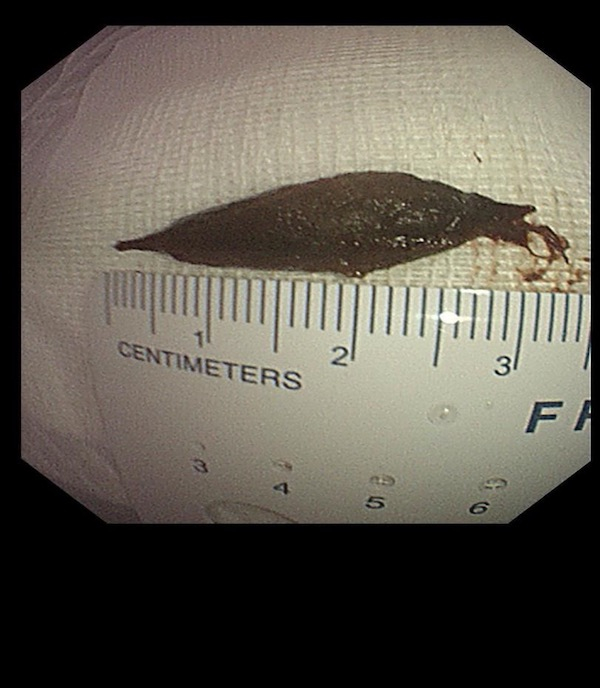 图说：老人误吞的枣核 医院供图（下同）