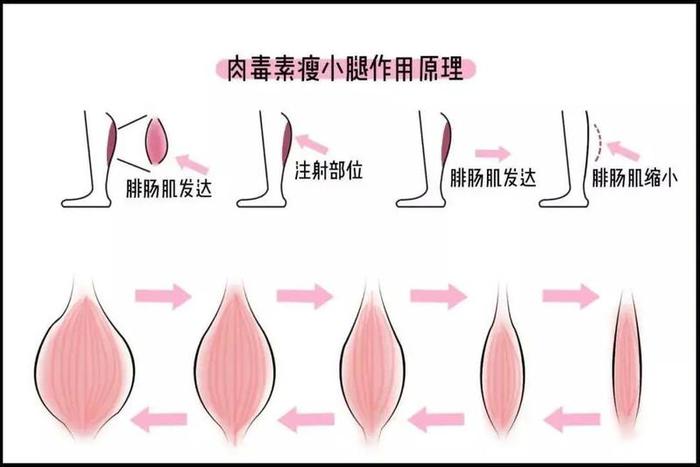 肉毒素有毒？深圳女子用它瘦身竟中毒住院…注射前，你要知道这些