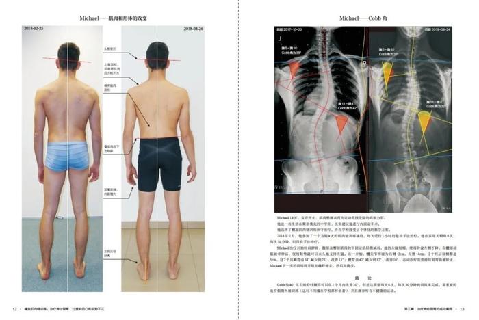 好书推荐 | 令人尖叫的技术---螺旋肌肉链训练·第3册震撼上市---治疗脊柱侧弯、过度前前后凸和姿势不正