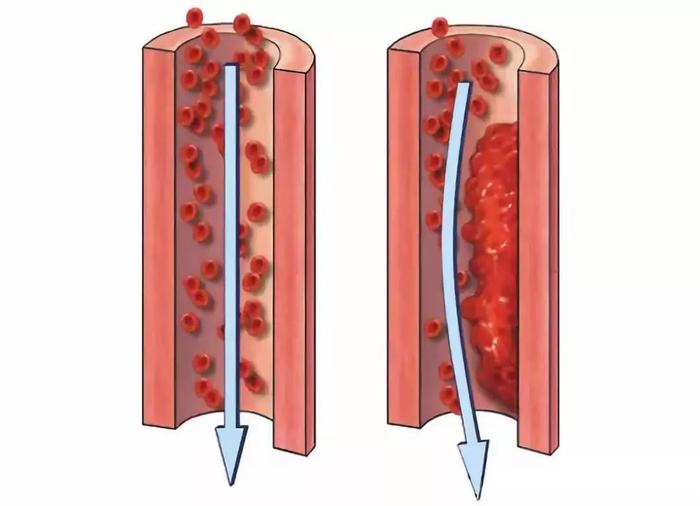 三大院士呼吁：99%的血栓无征兆，记住一个字，一生无栓
