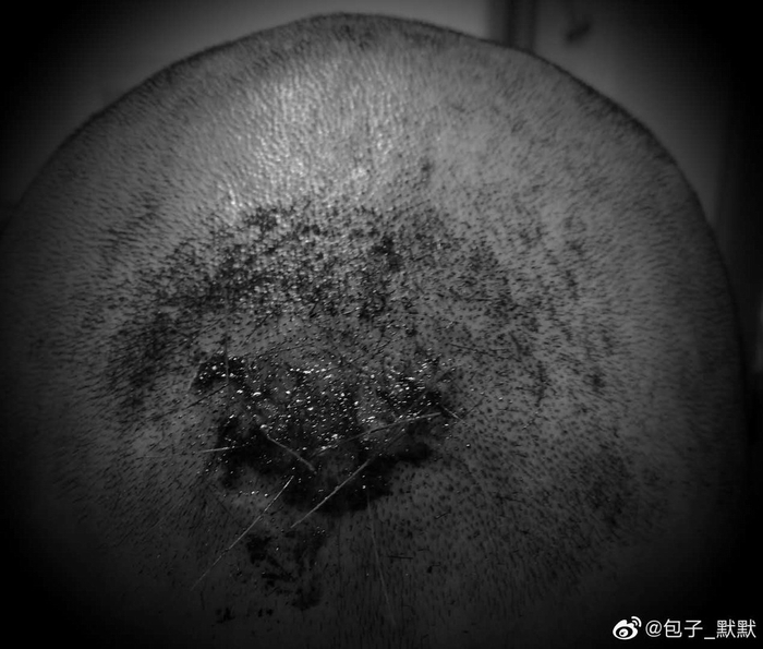  小默头上的伤疤。受访者供图 &nbsp;