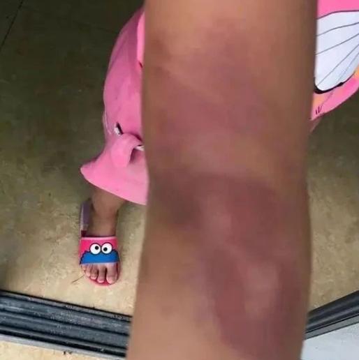 身上多处淤青！柳州融水10岁女生遭老师殴打？回应来了