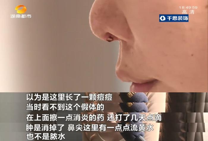 湖南一女子整容后鼻子破了个洞，假体露了出来！要求换方式再整，长沙禾丽医疗美容：“地摊货”换“LV”可能吗？