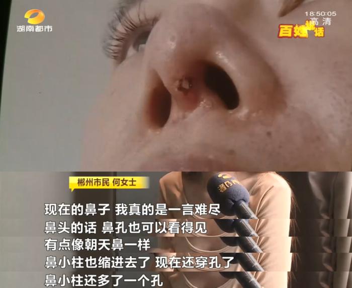 湖南一女子整容后鼻子破了个洞，假体露了出来！要求换方式再整，长沙禾丽医疗美容：“地摊货”换“LV”可能吗？