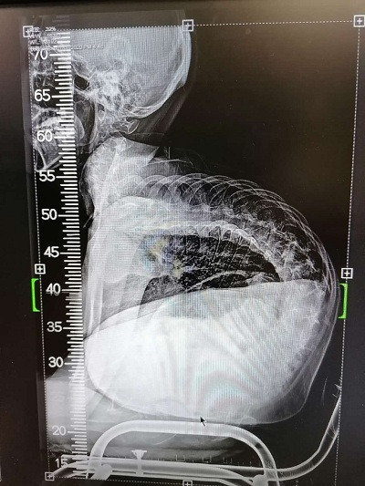 图说：因患有罕见病脊髓性肌萎缩症，小徐脊椎严重弯曲 采访对象供图/下同