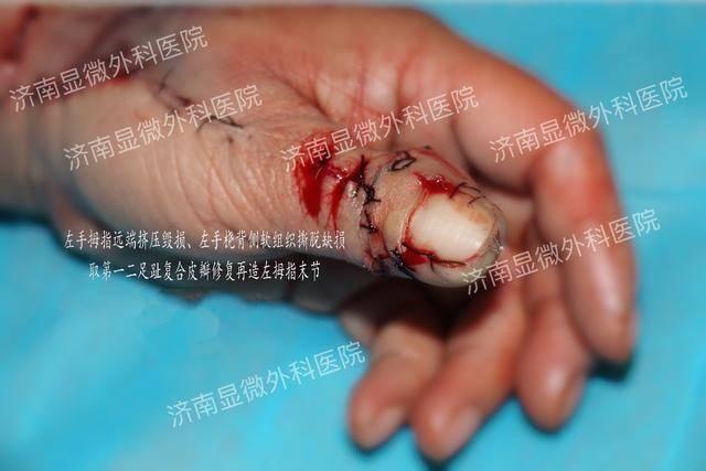 工伤导致男子拇指被斩断，3D全形手指再造术将手指复原！