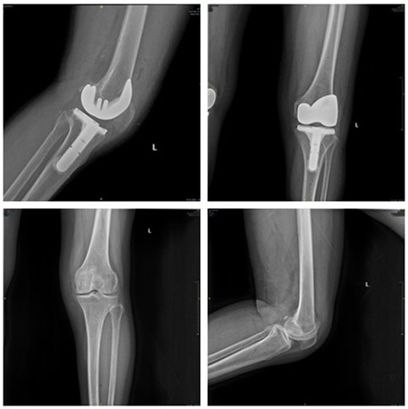 图说：上海第九人民医院团队为女性患者完成了全膝关节置换术 采访对象供图（下同）