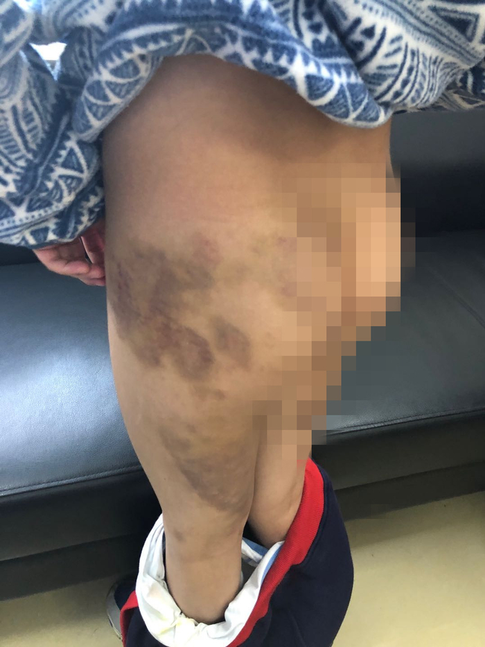  朱某大儿子的伤势&nbsp; &nbsp;松江区检察院供图