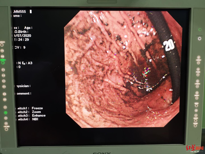 ↑手术后，胃里的头发基本被清除干净 　　四川大学华西医院供图
