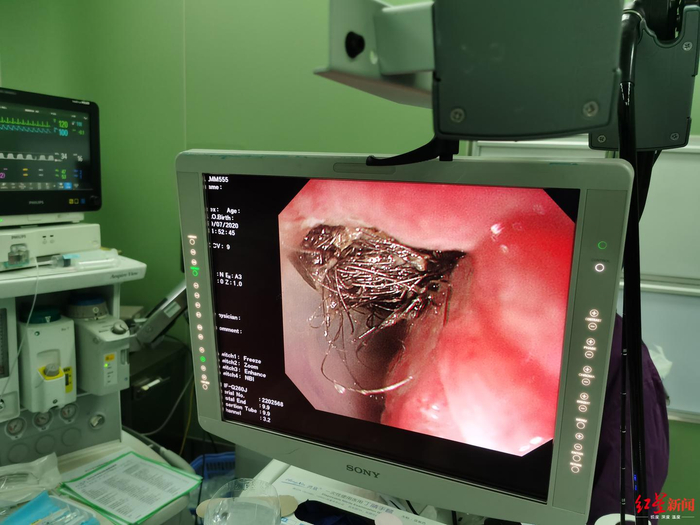 &nbsp;↑胃镜下看到，点点胃里全是缠绕的头发