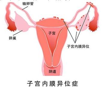 痛经就是子宫内膜异位症吗？济南青华医院医生为您解析！