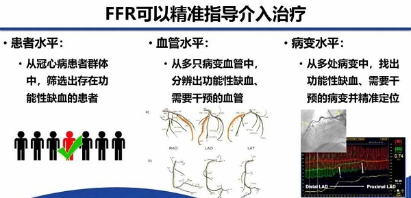 图说：以FFR指导的治疗策略被证实安全、经济，并能改善患者预后 采访对象供图